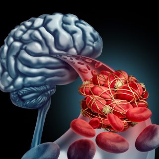 Blood clot and the brain