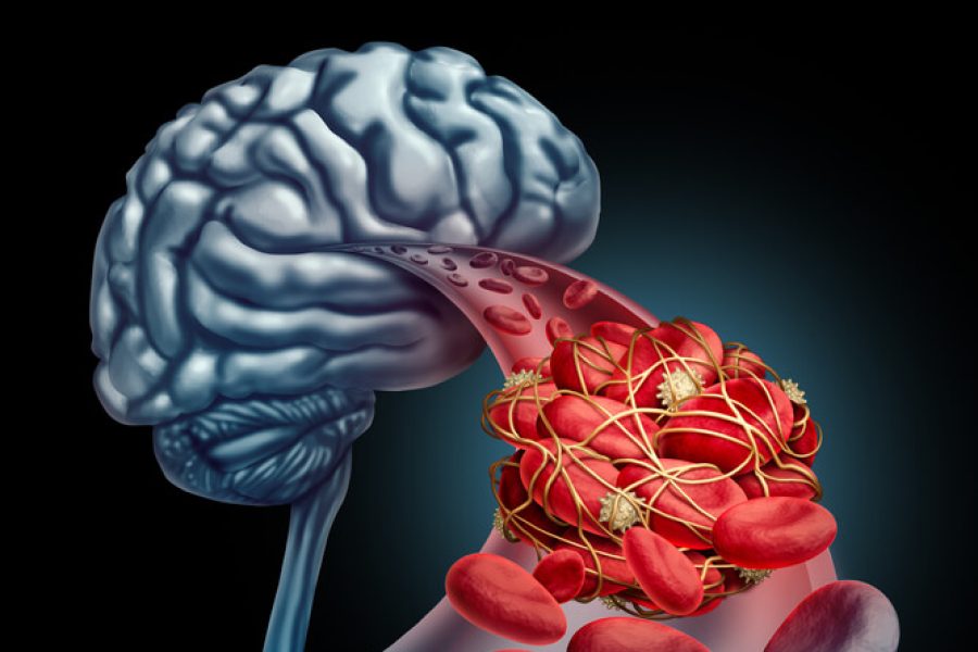 Blood clot and the brain