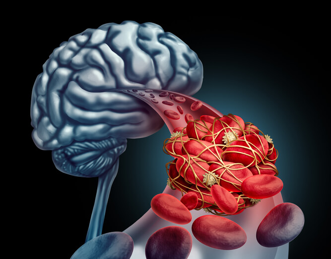Blood clot and the brain