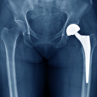 Xray of a hip implant