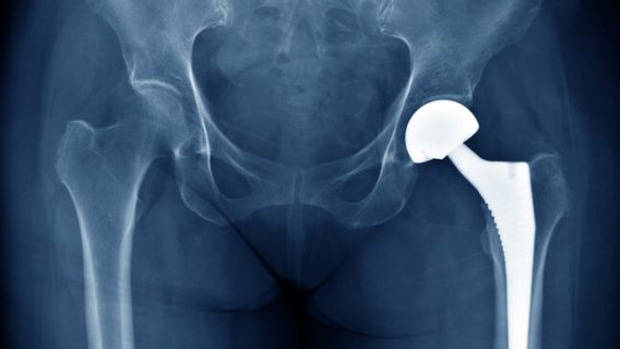 Xray of a hip implant