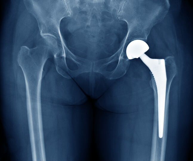 Xray of a hip implant