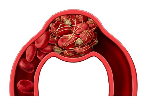 3D illustration of blood clot disease