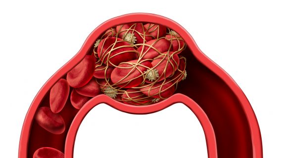 3D illustration of blood clot disease