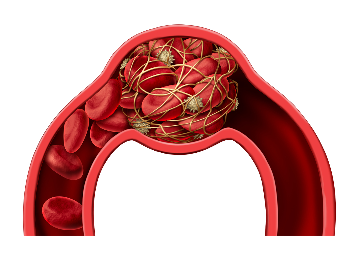 Blood clots: Do you know the signs?