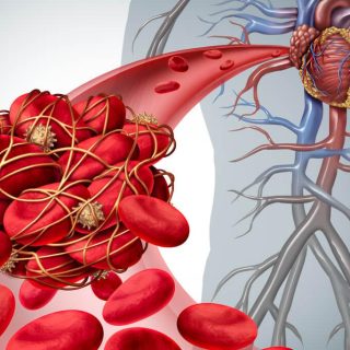 illustration of blood clot