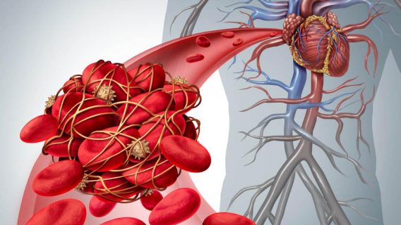 illustration of blood clot