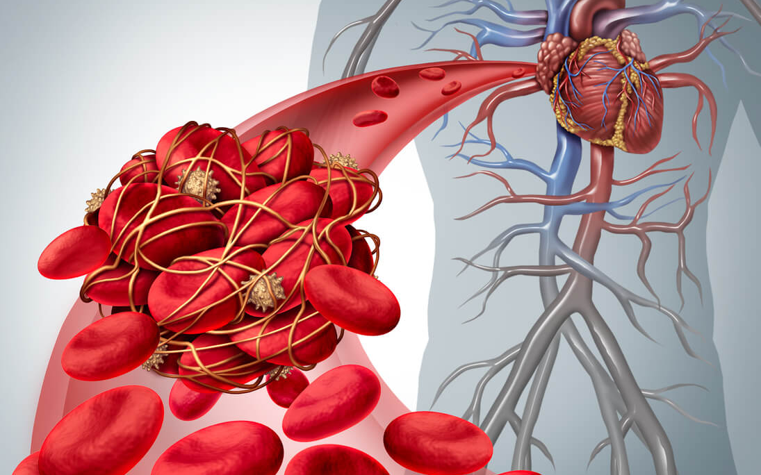 illustration of blood clot