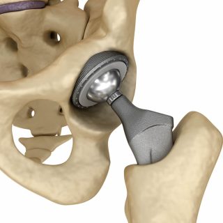 Metal hip implant model