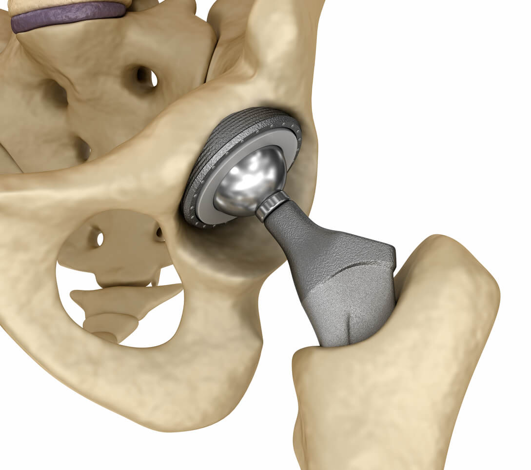 Metal hip implant model