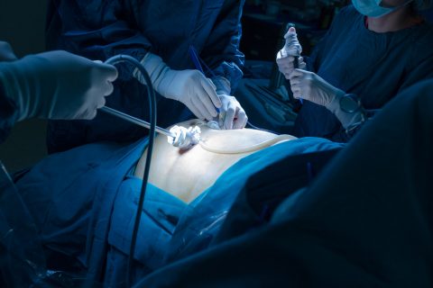 procedure using laparoscopic medical device