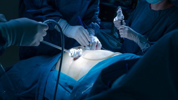 procedure using laparoscopic medical device