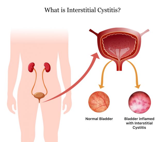 Interstitial cystitis causes inflammation and irritation in the bladder walls