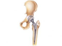 Hip Replacement Illustration