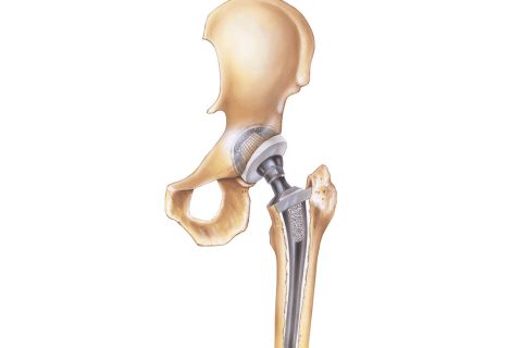 Hip Replacement Illustration