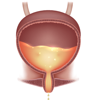 Diagram of SUI causing urine leakage