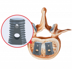 Infuse Bone Graph Implant