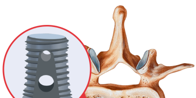 Infuse Bone Graph Implant