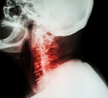 Disc Pain X-Ray