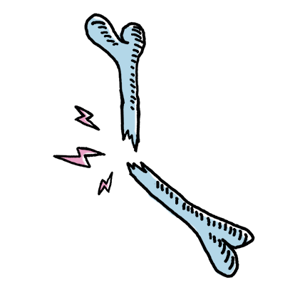 Illustration of fractured bone