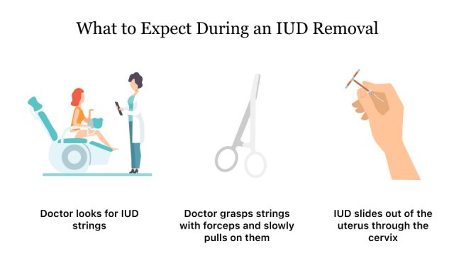 Insertion after iud side effects Mirena Side