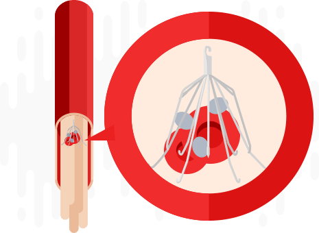 IVC Filter Removal