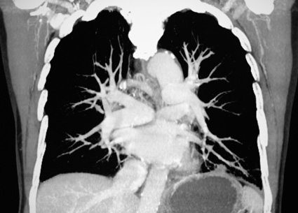 Pulmonary Embolism