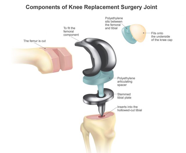 Components of knee replacement surgery joint