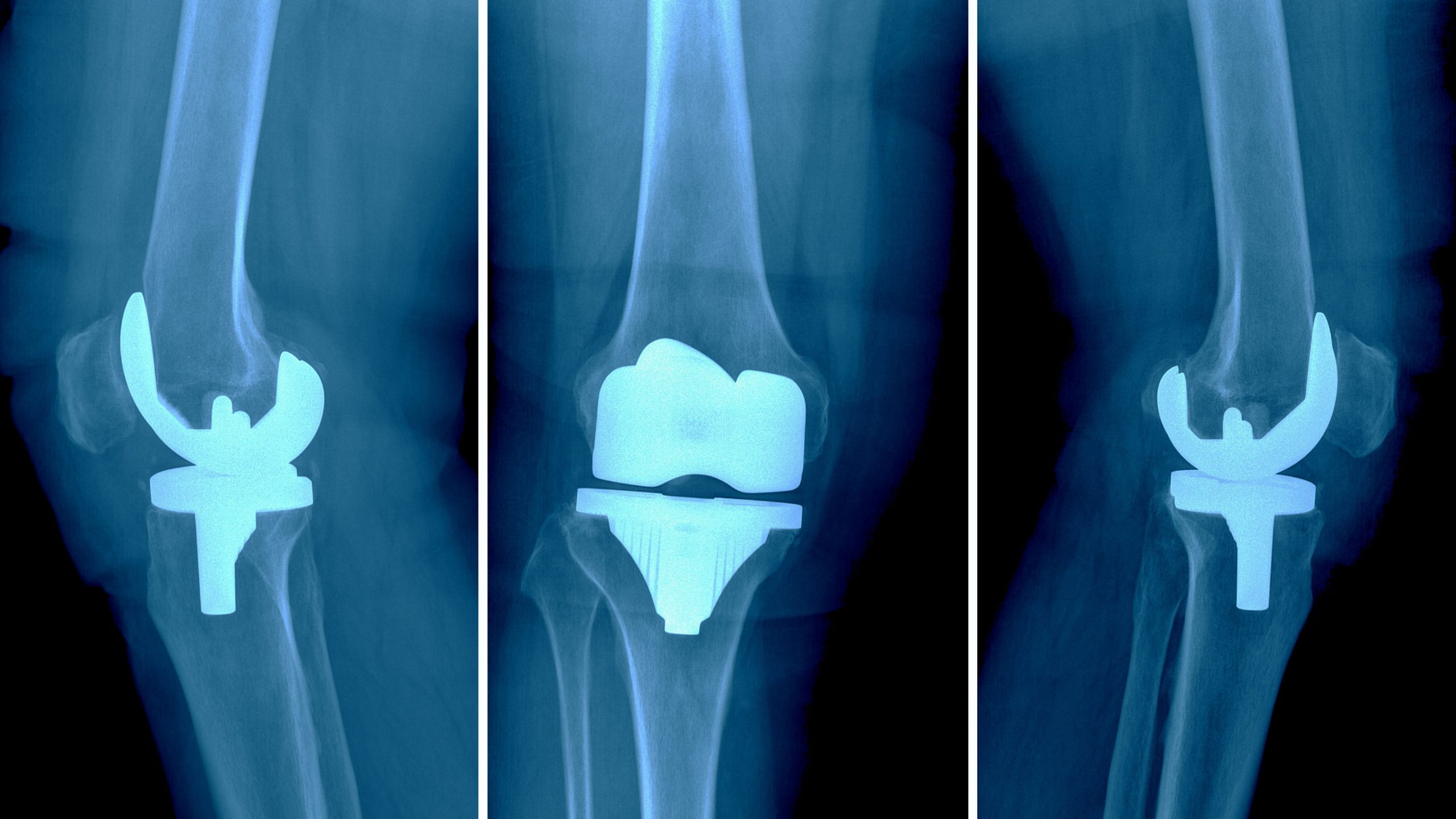 Knee Joint Replacement Devices