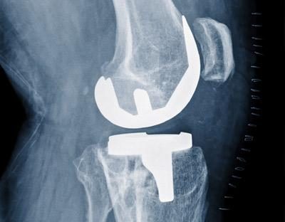 Knee Replacement X-ray