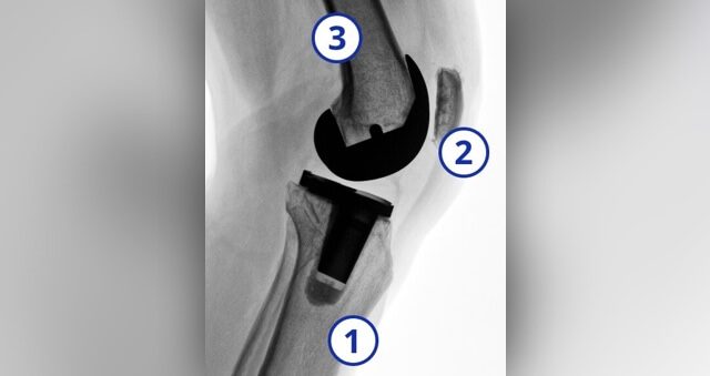 Knee replacement x-ray with femur, patella, tibia numbered