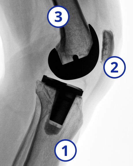 Knee replacement x-ray with femur, patella, tibia numbered
