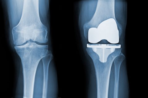 Knee replacement x-ray