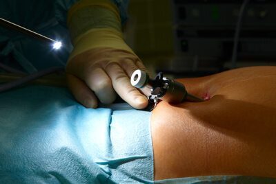 Laparoscopic Hernia Repair Surgery