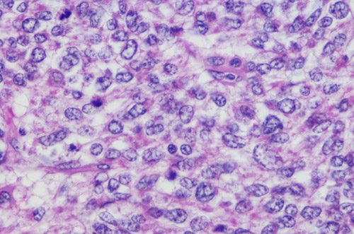 Micrograph of Leiomyosarcoma