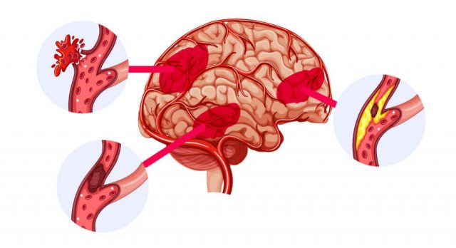 Lemtrada stroke illustration