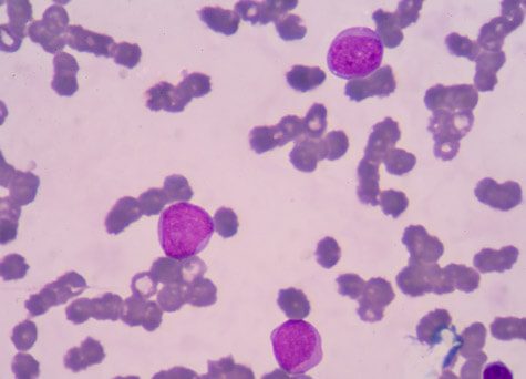 Illustration of leukemia cells