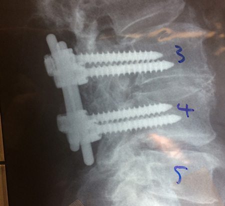 X-ray of Screws and Rods Attached to Vertebrae