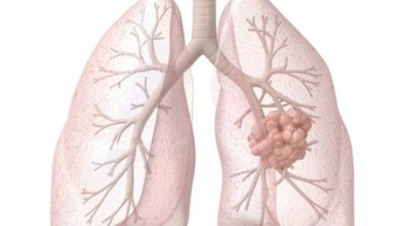 lung cancer diagram