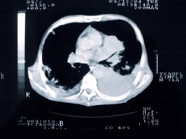 MRI of lung with cancer