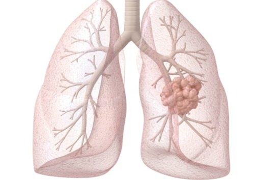lung cancer diagram