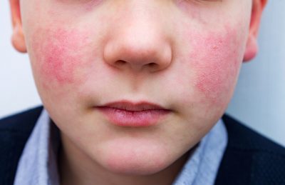 Rash shop on face