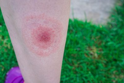 Lyme Disease, or erythema migrans