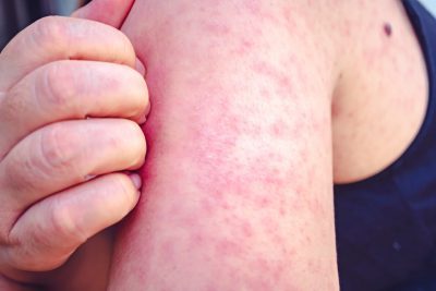 Skin Discoloration With Lupus: Red Spots, Orange Spots, and More