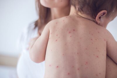 Child with chickenpox