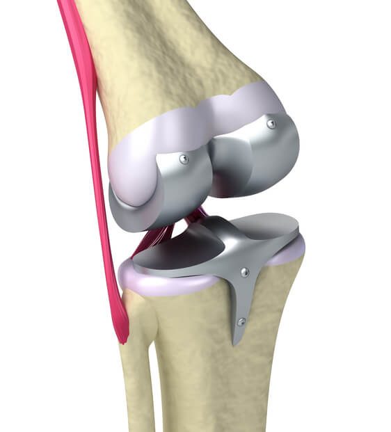 knee joint replacement devices