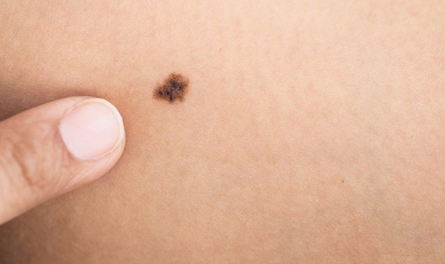 Melanoma spot on skin