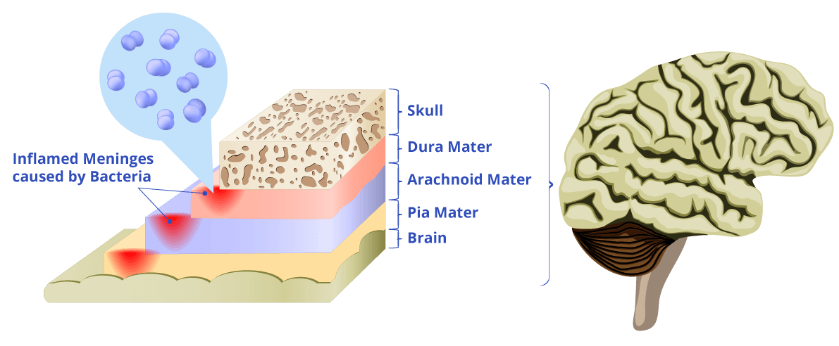 Menegitis diagram