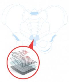 Transvaginal Mesh Implant and pelvic bone