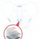 Transvaginal Mesh Implant and pelvic bone